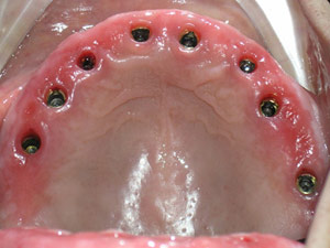 Implant Before