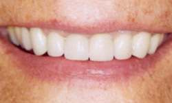 veneer after