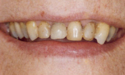 veneer before